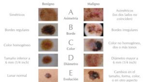 abcde melanoma esp